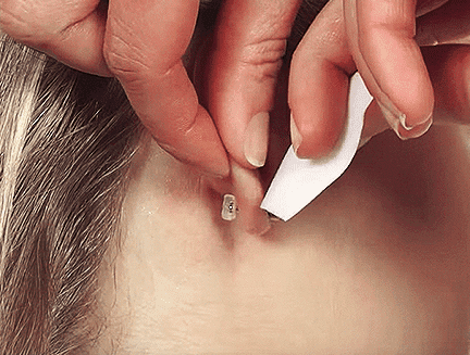 Blomdahl medical ear piercing system clearance